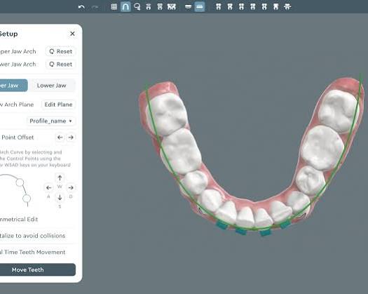 Planificación digital de movimiento dental